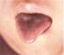 Diagnóstico por la lengua pequeña y delgada en la Medicina Tradicional China